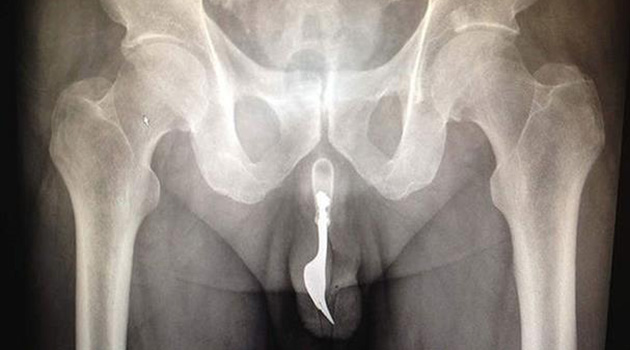 fork in penis